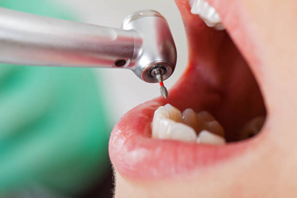 Urgent Tooth Repair in OR